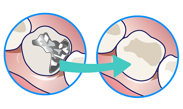 セラミック治療の比較画像