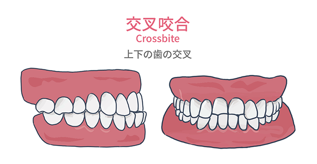 交叉咬合