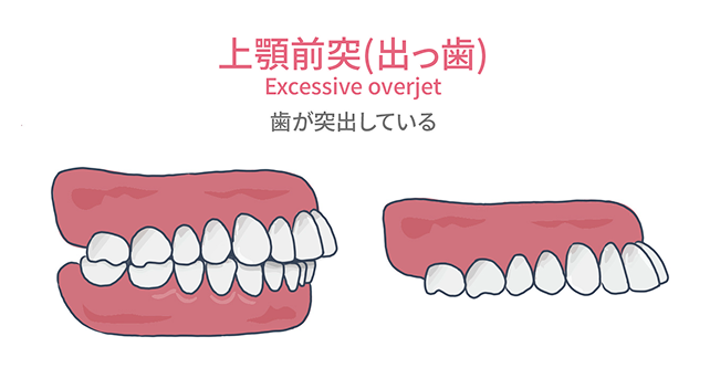 上顎前突（出っ歯）