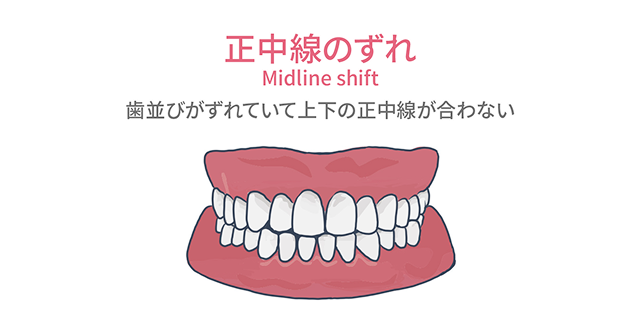 正中線のずれ