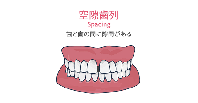空隙歯列