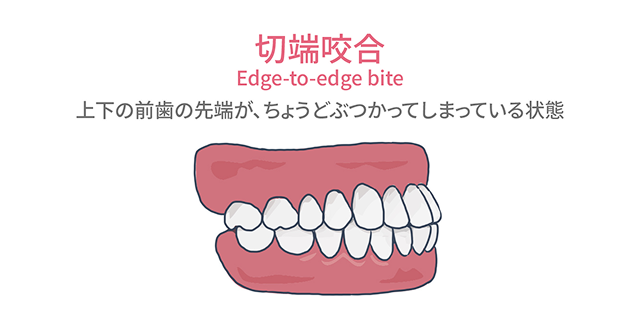切端咬合