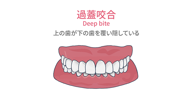 過蓋咬合