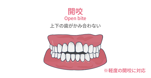 開咬