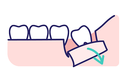 十分に麻酔が効いたら切開します。