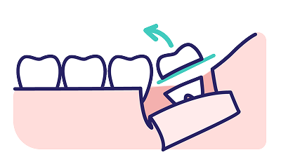 親知らずの状態によっては分割します。