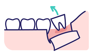 エレベーターという器具で、歯を脱臼させ、抜歯します。