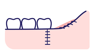 歯肉を縫合します。