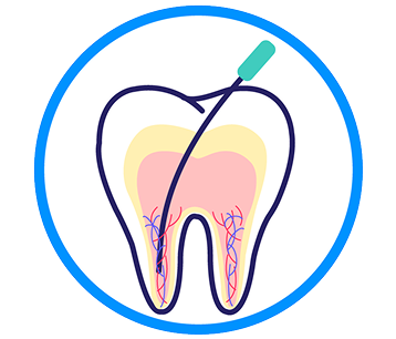 根管治療について