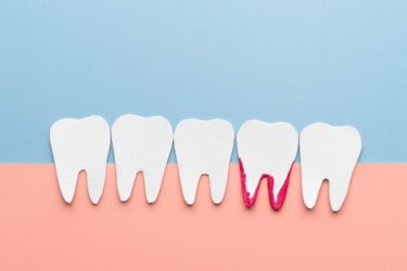 手遅れな歯周病の5つの症状！歯周病の進行段階と治療法をわかりやすく解説
