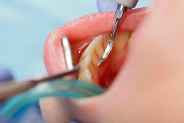 スケーリングとは？歯石を除去する効果や治療後の注意点について解説