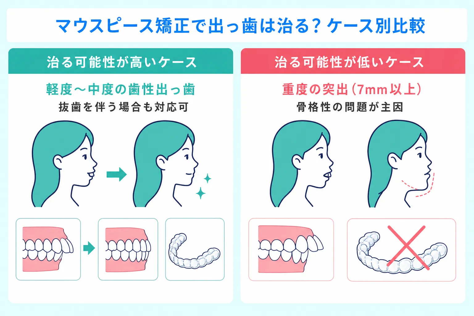 マウスピース矯正で出っ歯が治る場合と治らない場合を比較