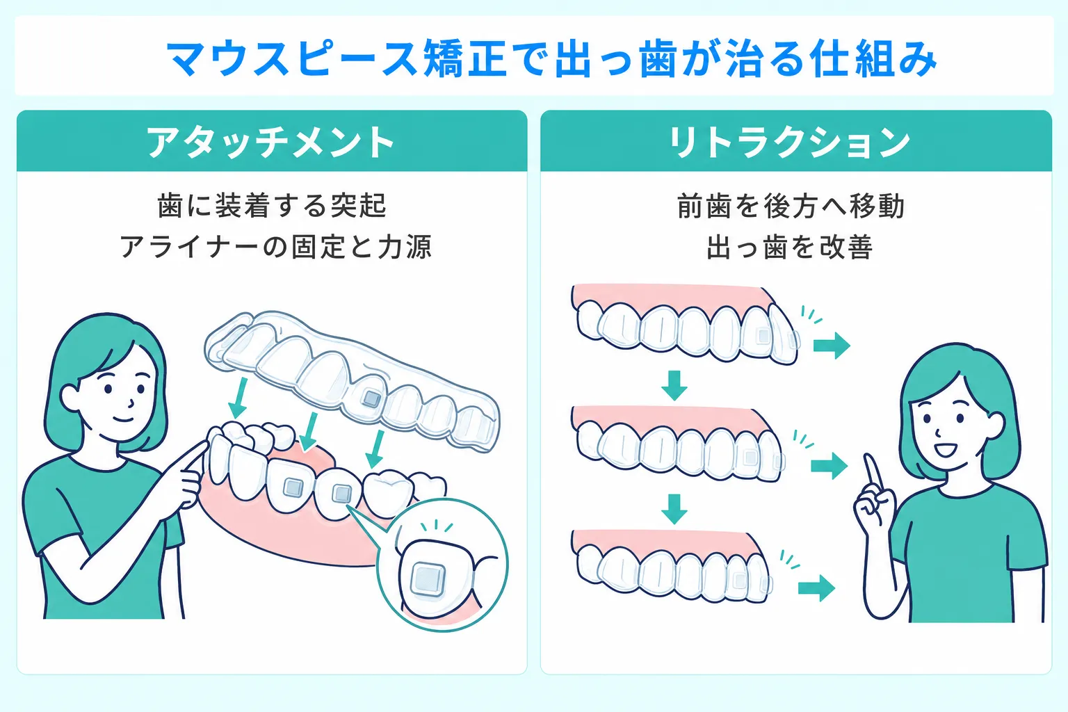 マウスピース矯正で出っ歯が治る仕組みを解説