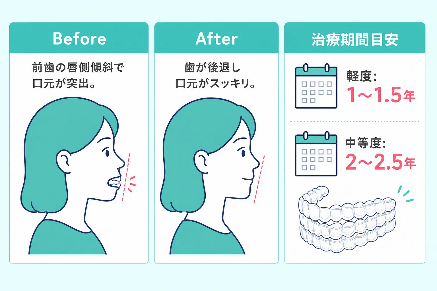 マウスピース矯正で口ゴボが治る場合の治療期間