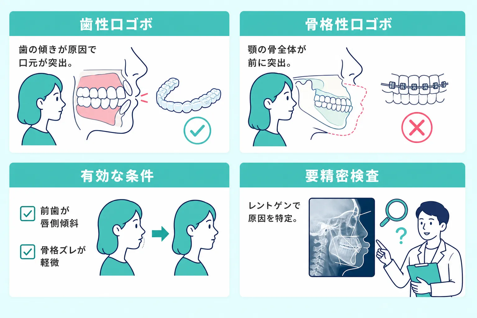 マウスピース矯正に有効な条件と口ゴボの種類
