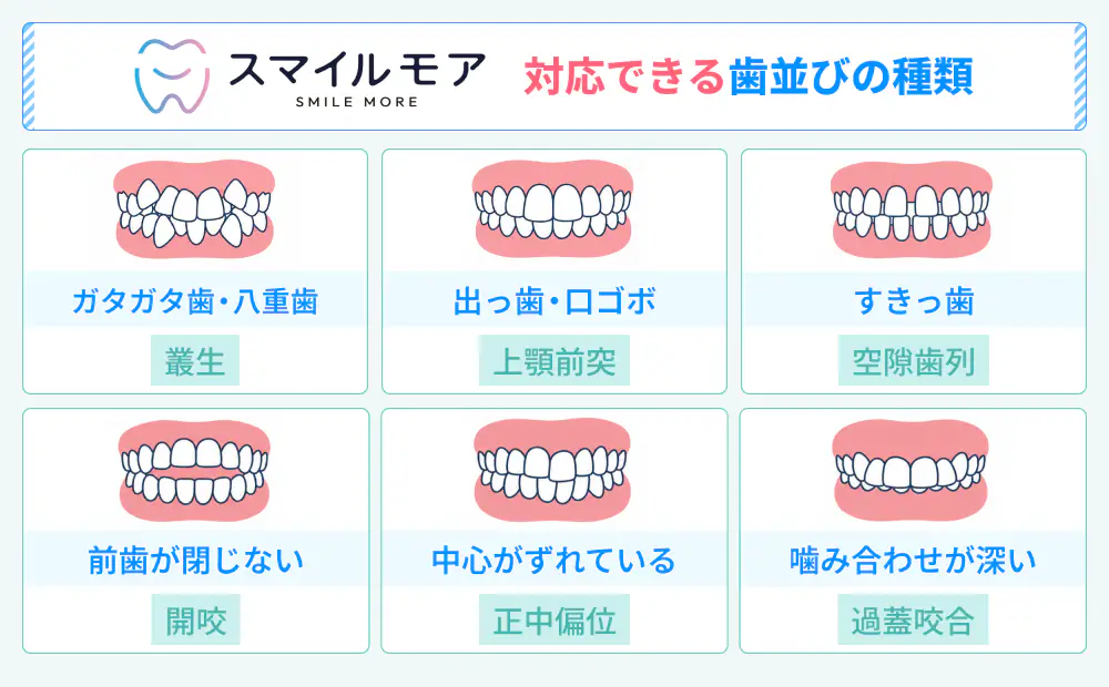 スマイルモアが対応する歯並びの種類