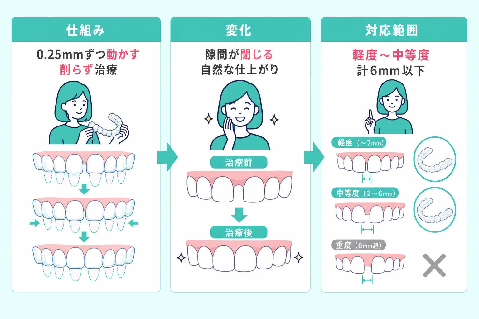 マウスピース矯正ですきっ歯を治せるのは6mm以下の場合で少しずつ動かして歯の隙間を閉じる仕組みであることを説明